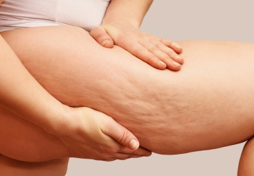 Lipedema vs. Cellulite: Key Differences & Diagnostic Tips.